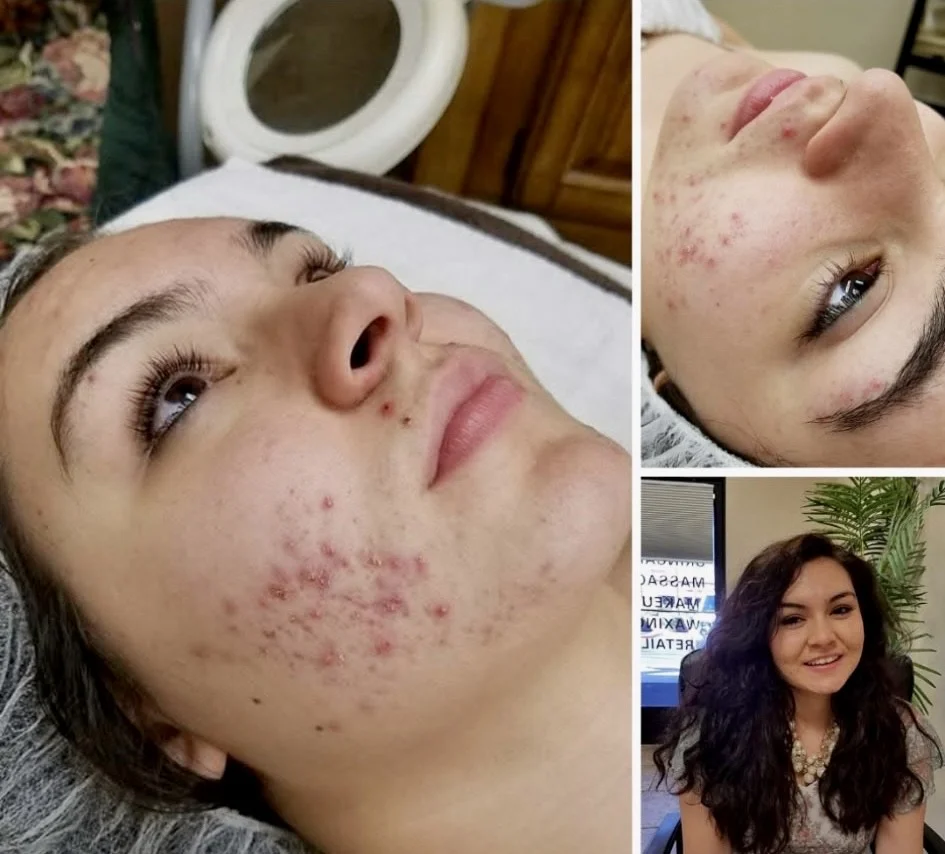 Acne Treatment